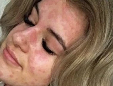 Δεν φαντάζεστε σε τι έχει αλλεργία αυτή η γυναίκα! (φωτο-βίντεο)